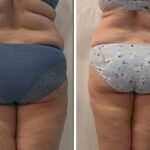 celiulito gydymas pries ir po rezultatai