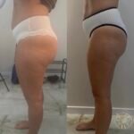 celiulito sumazejimas po endosferos terapijos