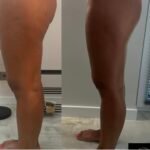 endosfera pries ir po rezultatai