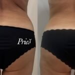 endosfera rezultatai pries ir po