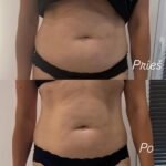 pilvo apimciu mazinimas su endosferos terapija