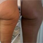 slaunu liekninimas su endosfera